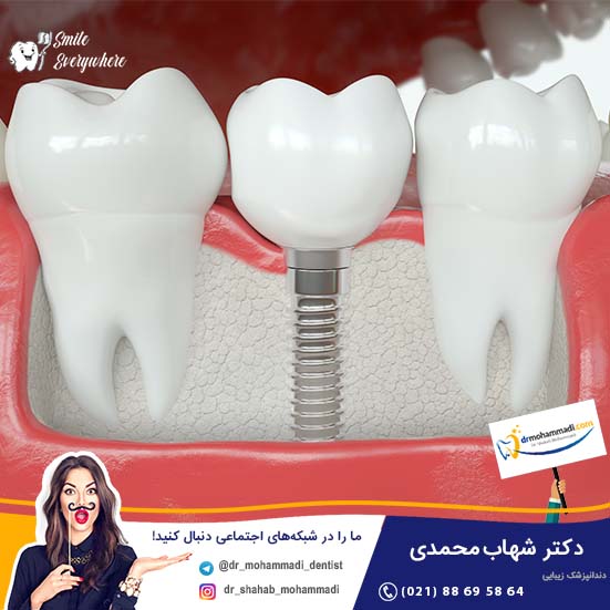 کاشت ایمپلنت چه تاثیری روی دندانهای طبیعی مجاور دارد؟ - کلینیک دندانپزشکی دکتر شهاب محمدی